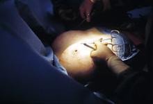 Kirurg udfører plastikkirurgisk plastikoperation.